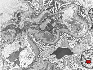 F,19y. | IgA nephropathy F,19y. | IgA nephropathy